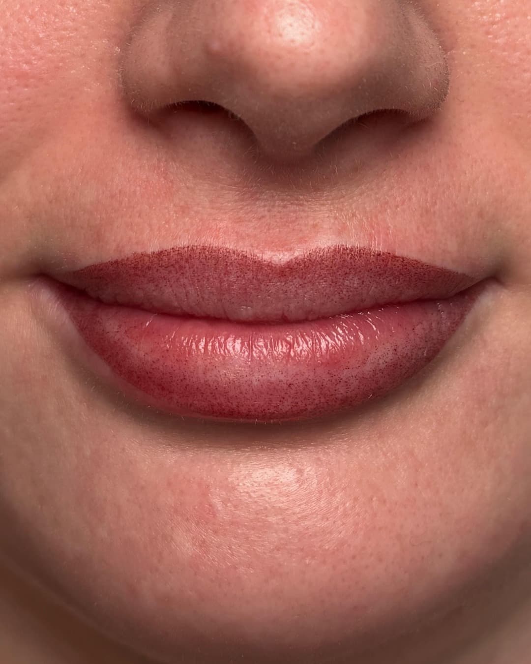 Softlips – Vorher & Nachher After