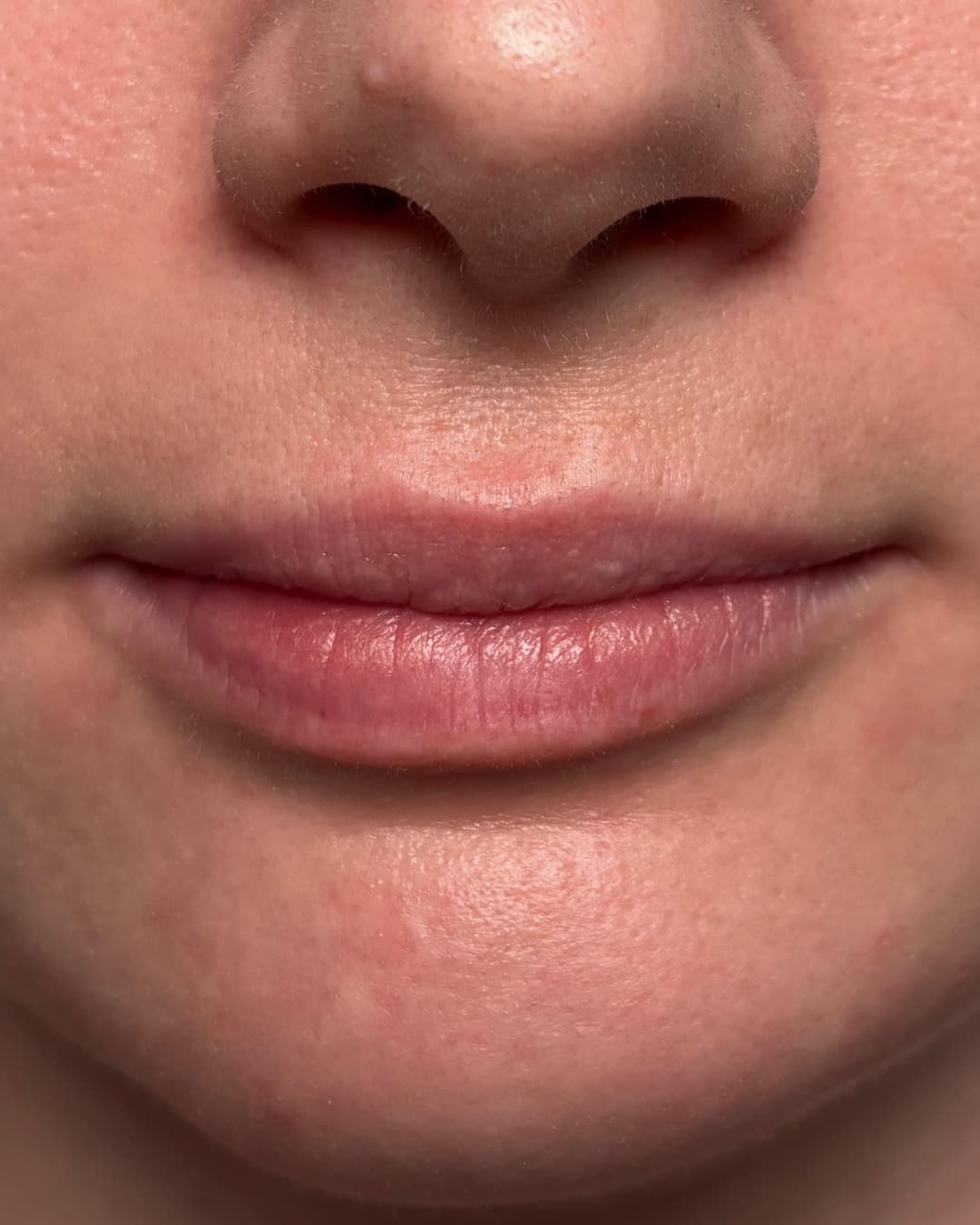 Softlips – Vorher & Nachher Before